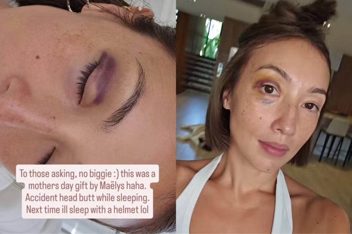 solenn-heussaff-sustains-black-eye-16may2025-1536×1022.jpeg